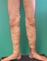 Venous Disease | Central Vascular Clinic